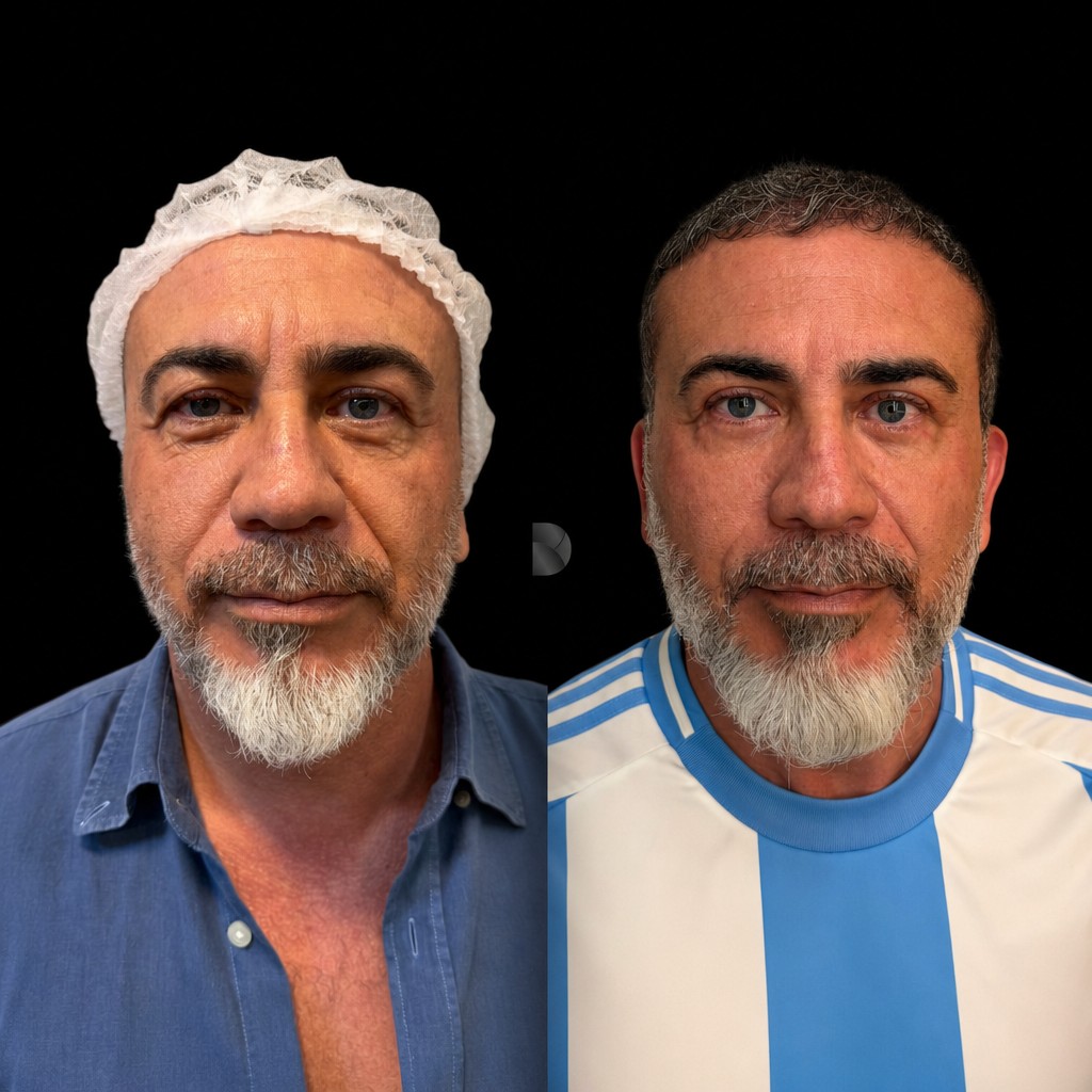 Antes e depois de blefaroplastia no Instituto Donna